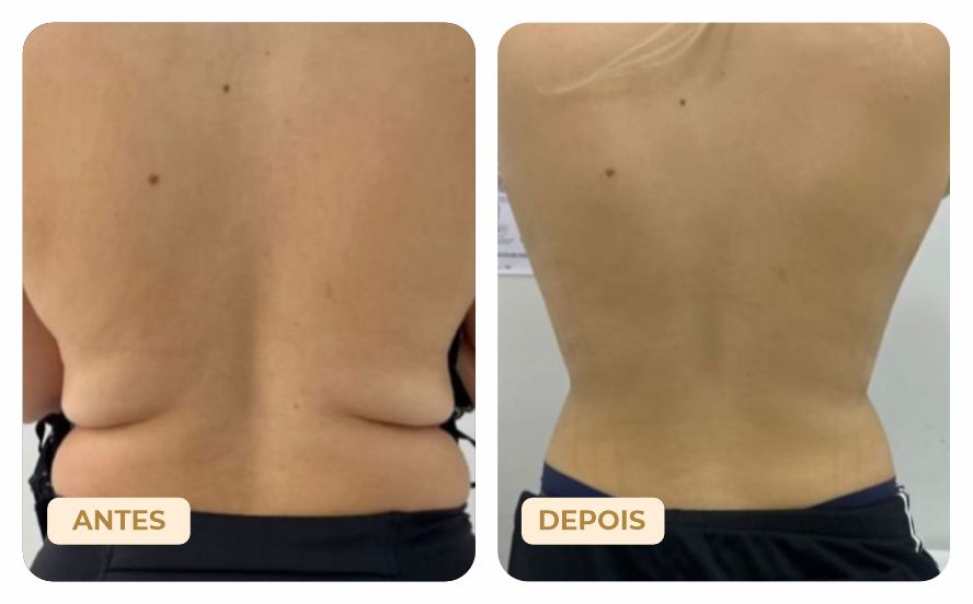 Antes e Depois Endolaser - Renove Saúde Integrada